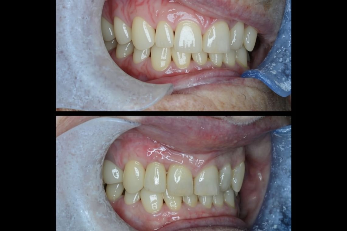 Before and after implant treatment at Burley