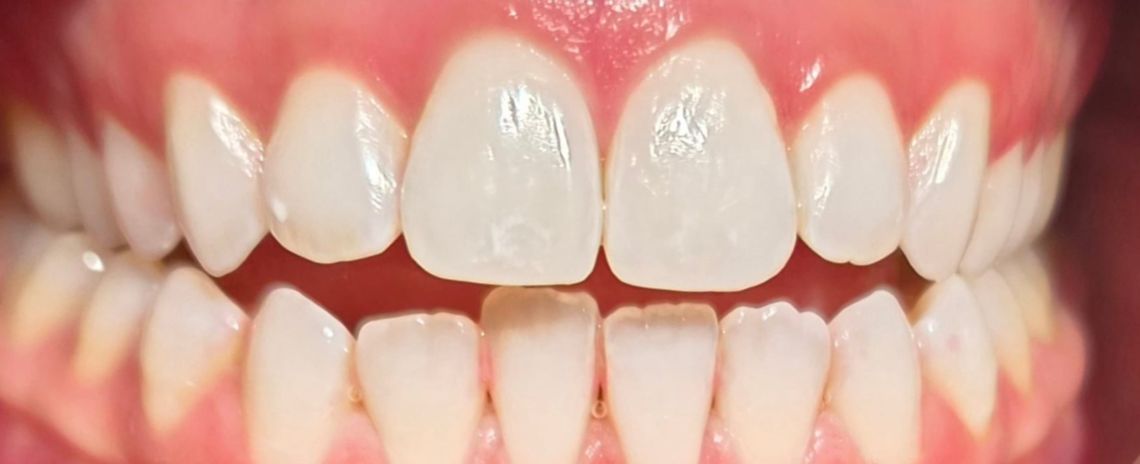  Whitening After