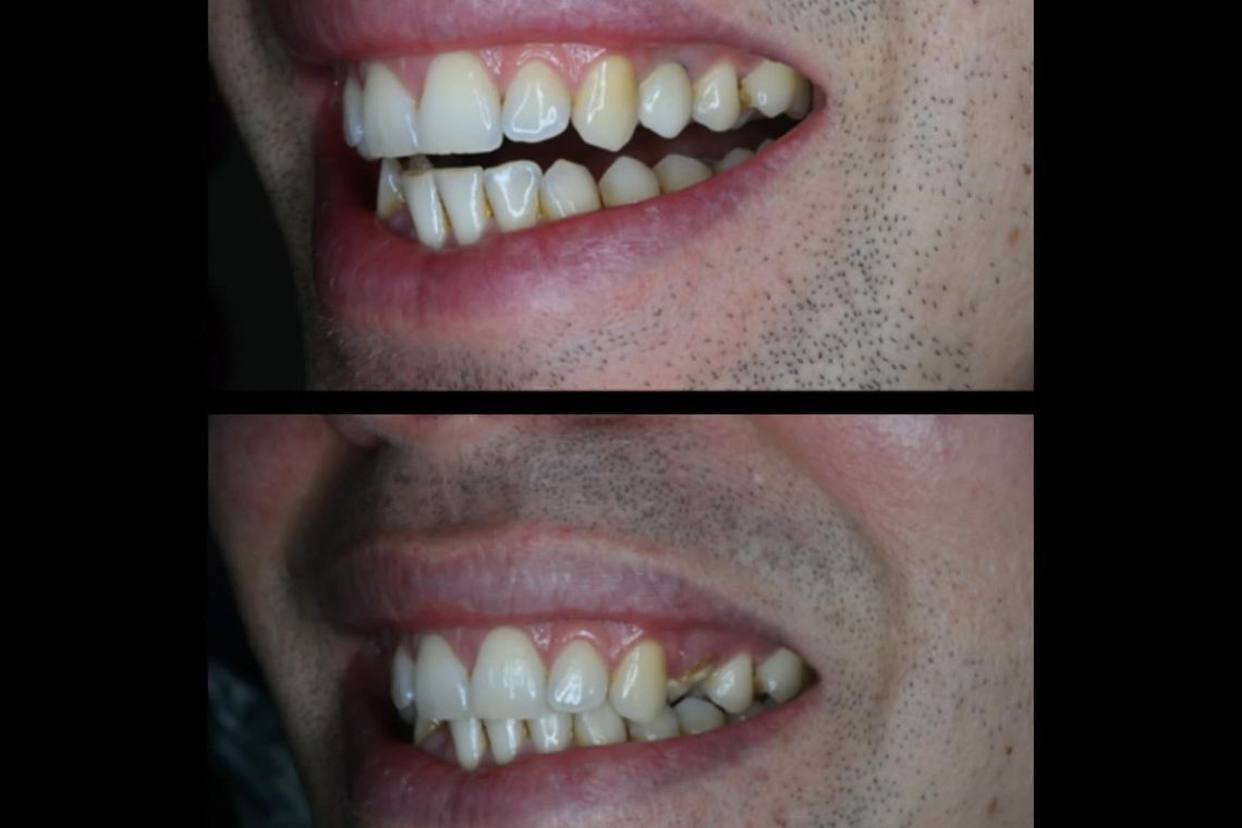 Before and after implant treatment at Burley
