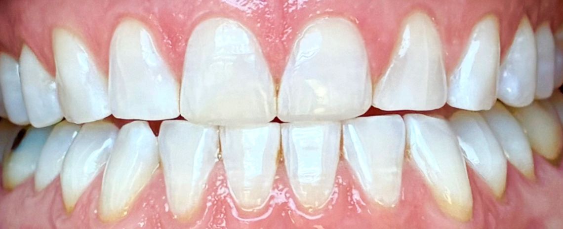  Whitening After