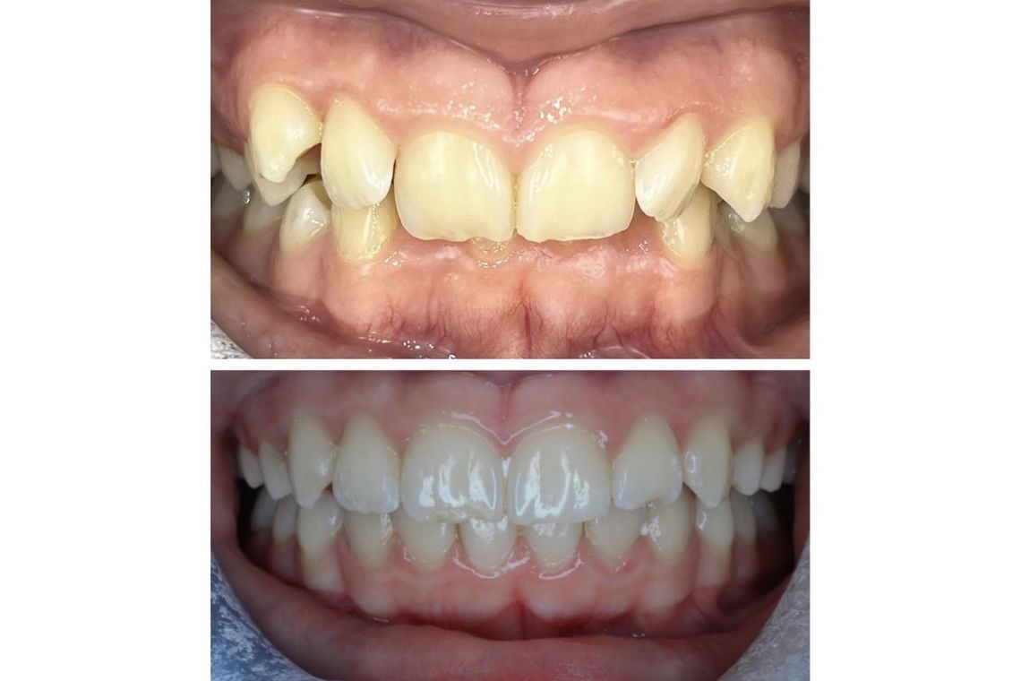 Before and after invisalign treatment at Burley