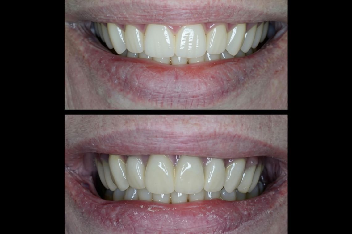 Before and after implant treatment at Burley