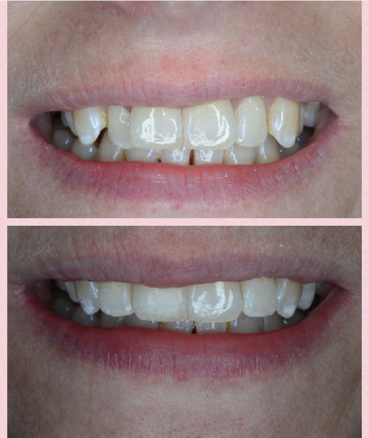Before and after composite bonding