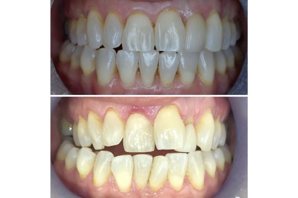 Before and after invisalign treatment at Burley