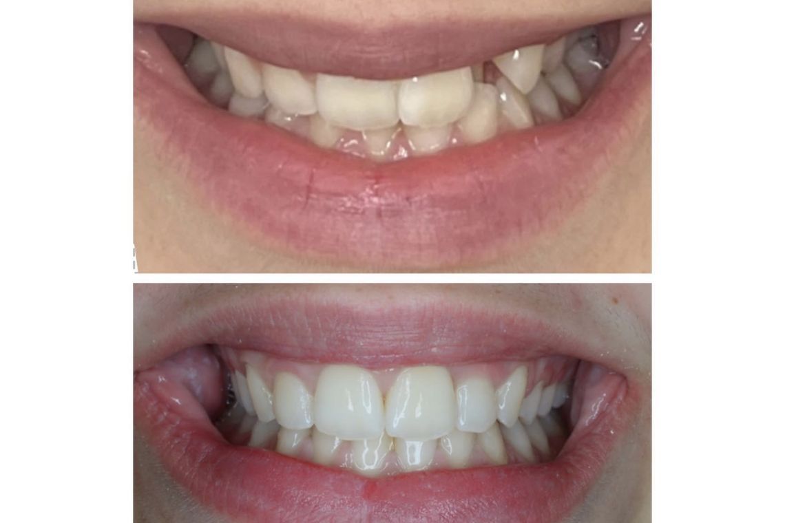 Before and after invisalign treatment at Burley