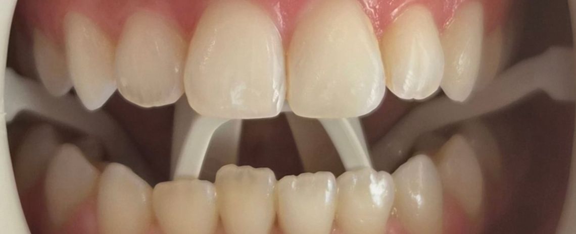 Whitening Before
