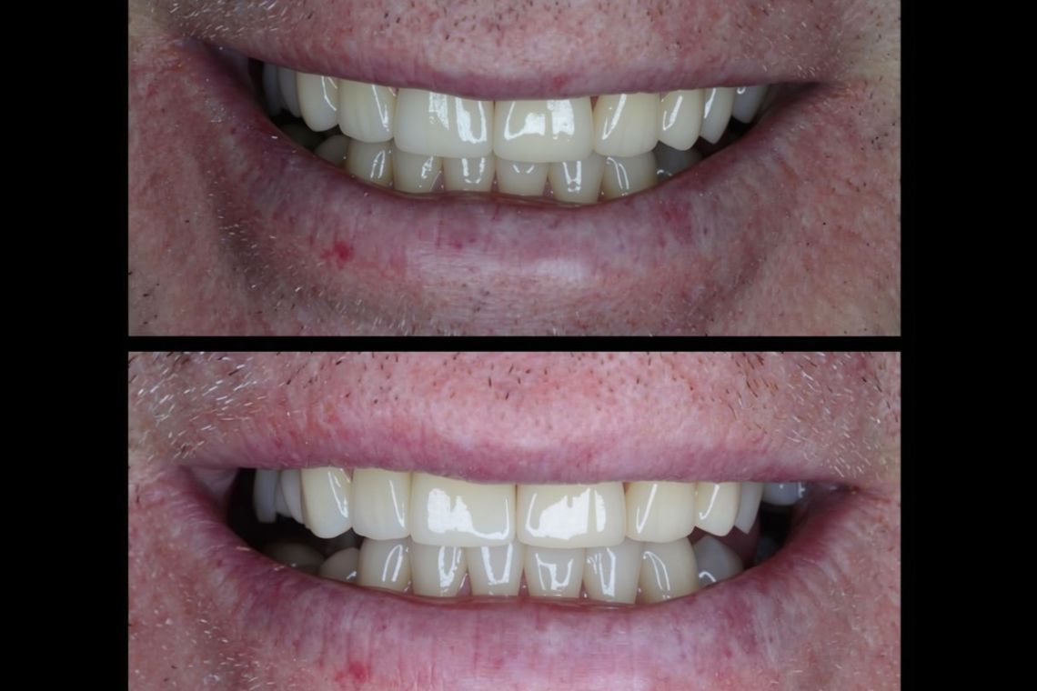 Before and after implant treatment at Burley