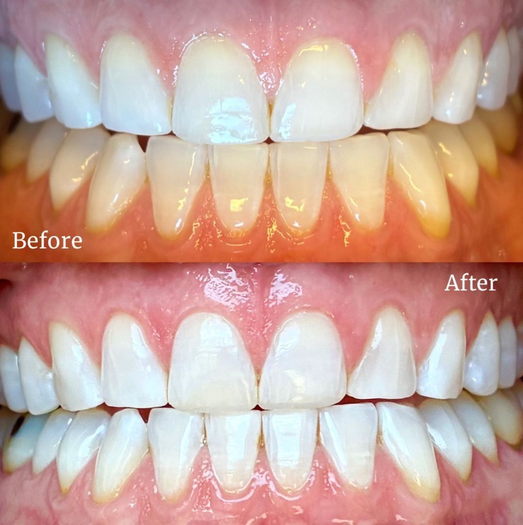 before and after