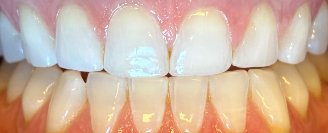  Whitening Before