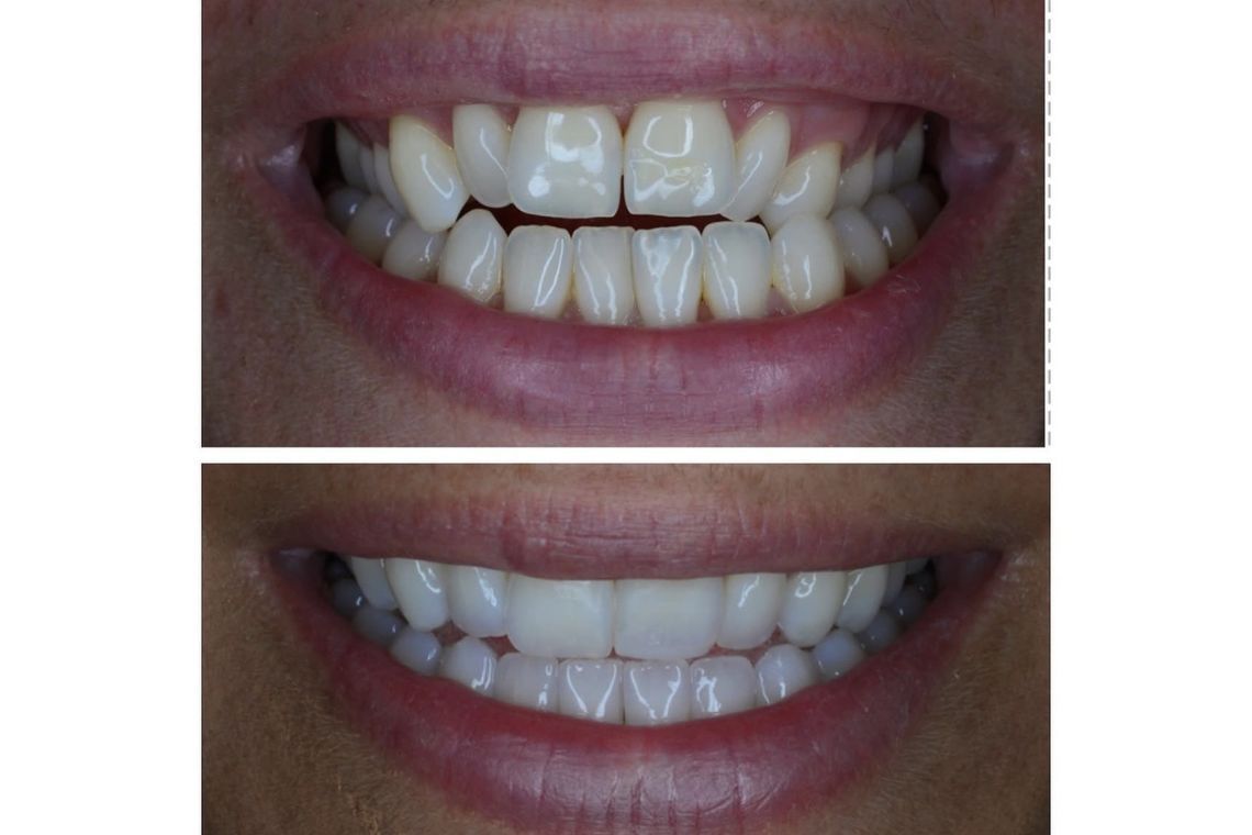 Before and after implant treatment at Burley