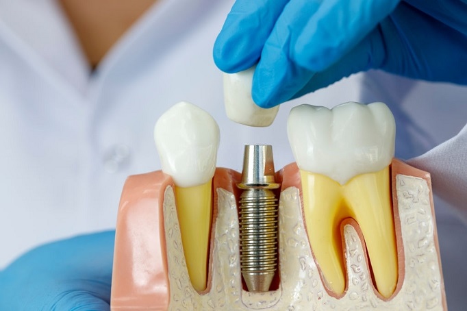 5 Reasons To Replace Missing Teeth | Dental Implants